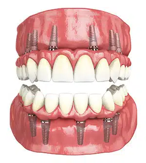The practice's Hybridge illustration showing connected upper and lower replacement teeth supported by implants in the jaw