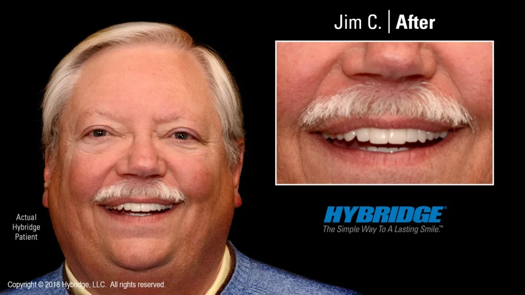 hybridge_jim_c_after