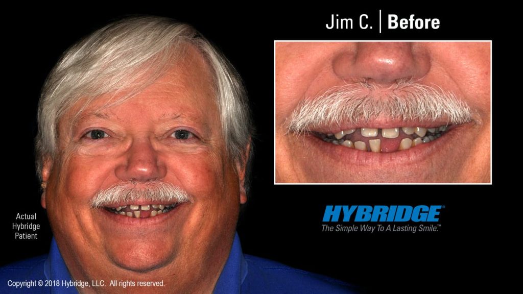 hybridge_jim_c_before-pichi