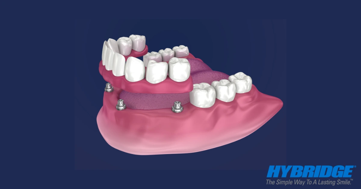 Hybridge Full Arch Restorations in Henderson, NV