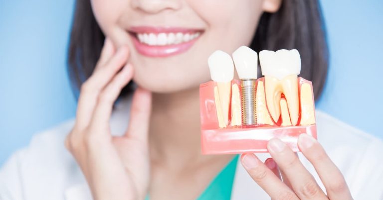 Dental Implants