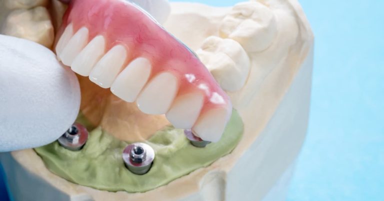 Professional full arch dental implants