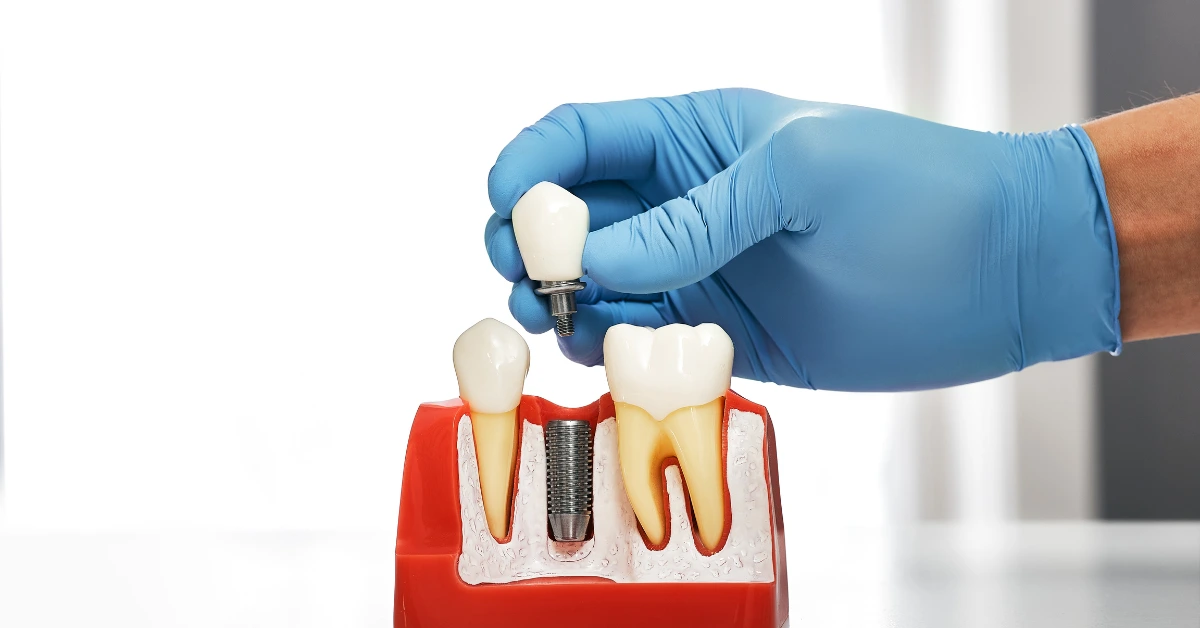 Model showing a crown being placed on a dental implant in a jaw cross-section
