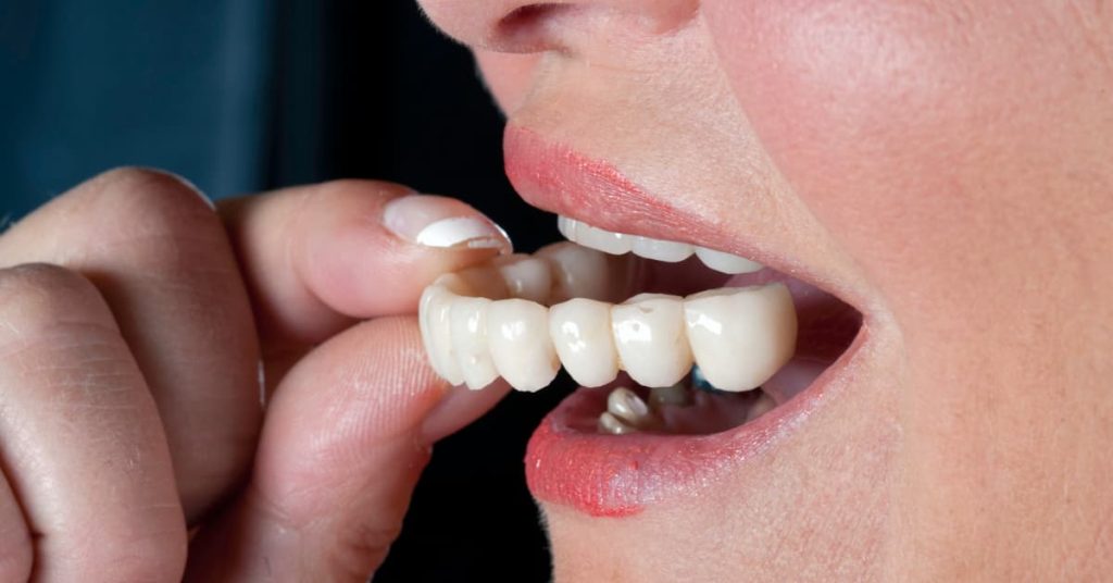 temporary teeth after dental implants