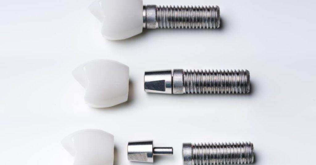 Full fixed arch implant cost guide