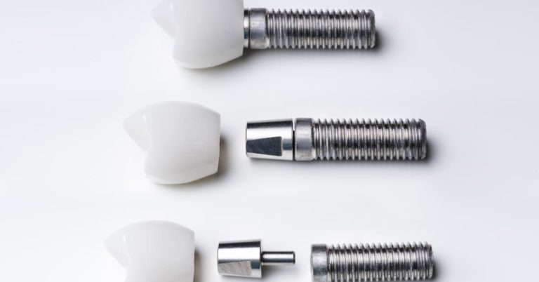 Full fixed arch implant cost guide