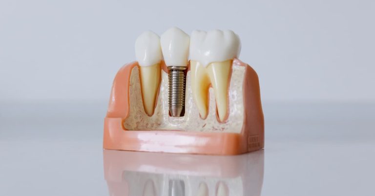 Professional full-size dental implants