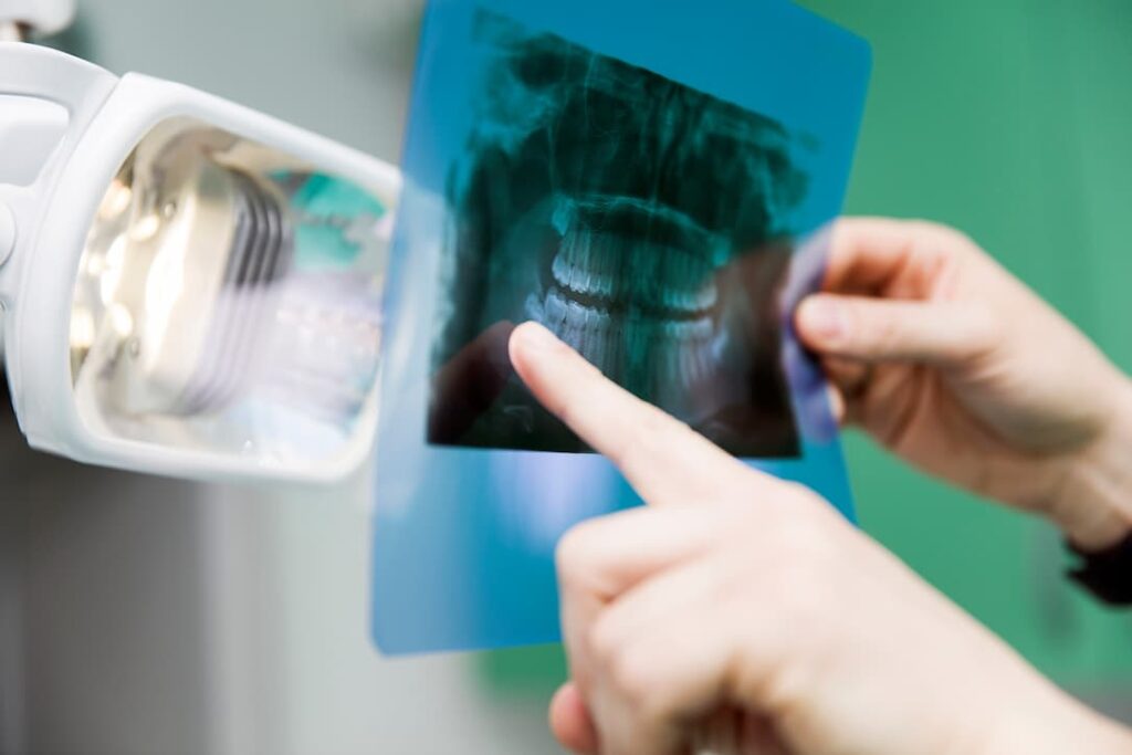 3D CBCT scan for a sinus lift upper jaw implant procedure