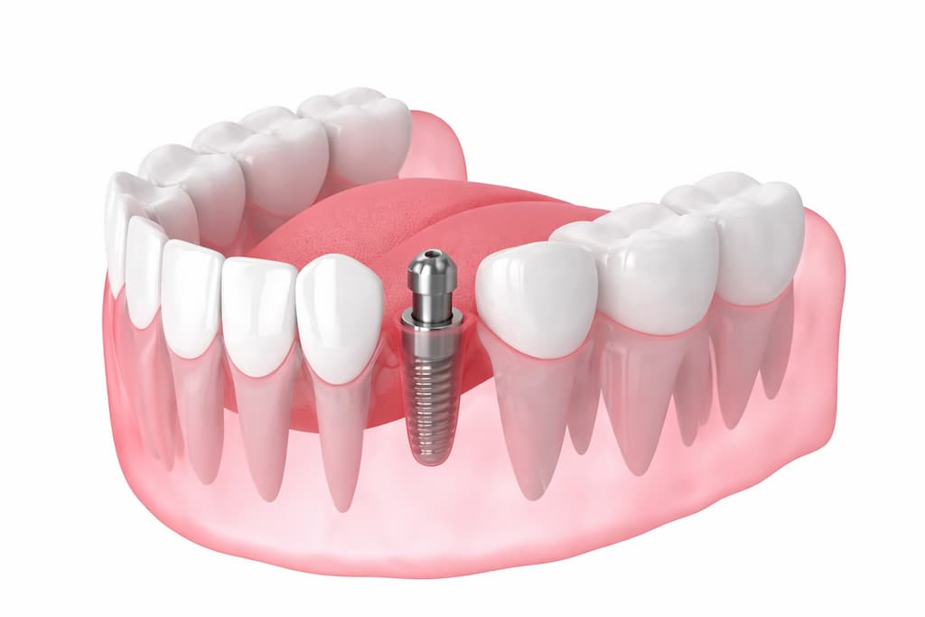 A temporary crown fitting on an implant healing abutment.