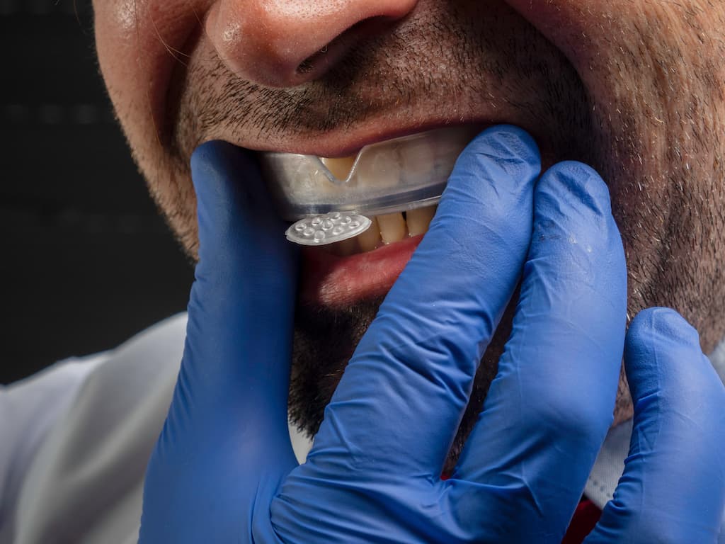 Dental Implants and Sports Protection: Essential Guide for Athletes and Active Adults