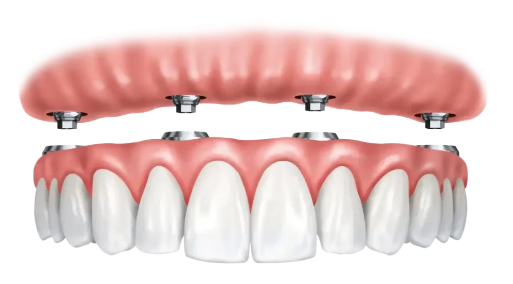 four-on-four upper jaw dental implants
