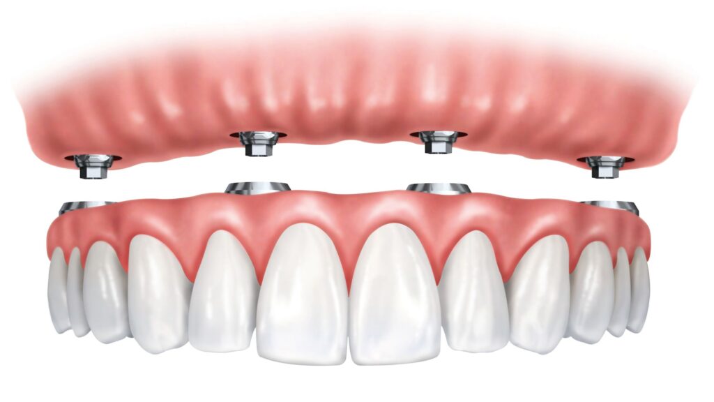 A full-arch implant