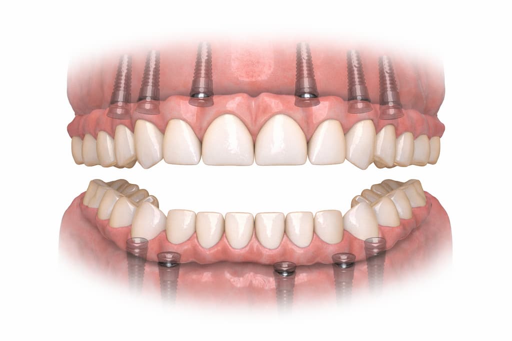 A Hybridge Implant system.
