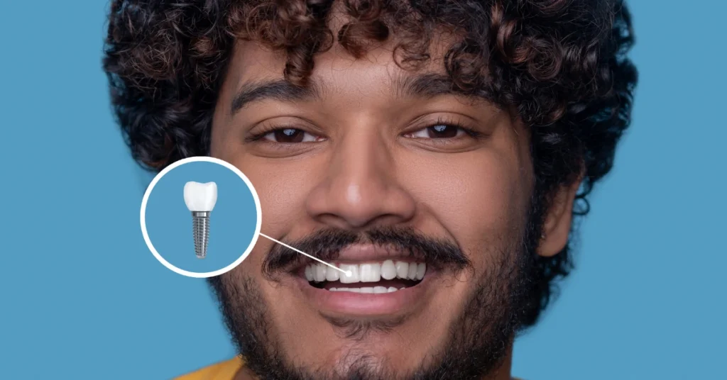 Emergency Dental Implants