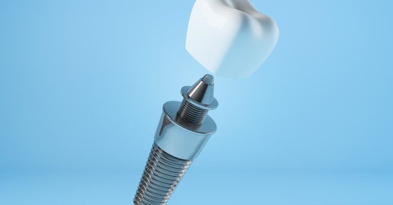 Failed dental bone grafts and what to do next