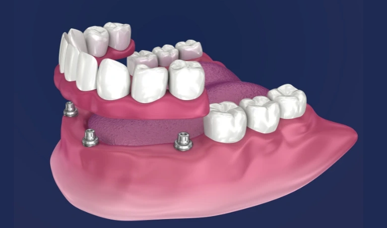 3D illustration of a connected implant-supported bridge attaching to implants in a lower jaw model