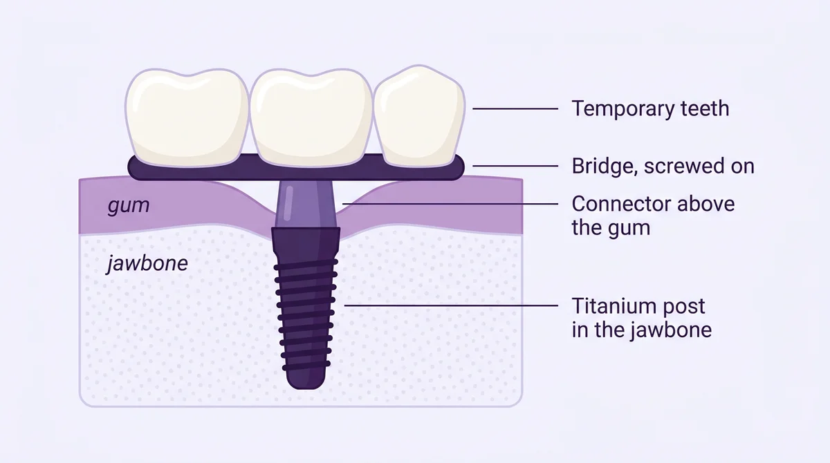 Cross-section of a dental implant after a full mouth extraction: titanium post in the jawbone, connector above the gum, and a temporary bridge screwed on