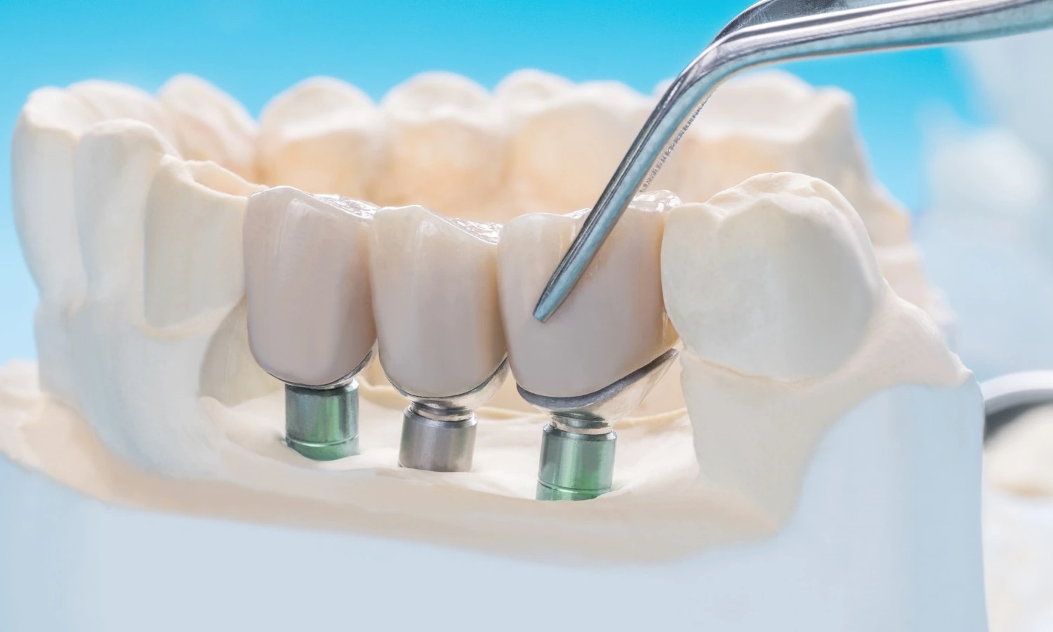 Dental model showing three replacement teeth joined over three implant supports, with a dental instrument pointing to the restoration.