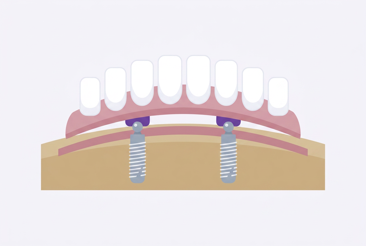 Denture with two housings on its underside clicked onto two implants in the bone